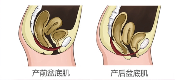 易舒美 | 产后盆底修复治疗|盆底肌修复仪器|产后康复仪-佛山市依士